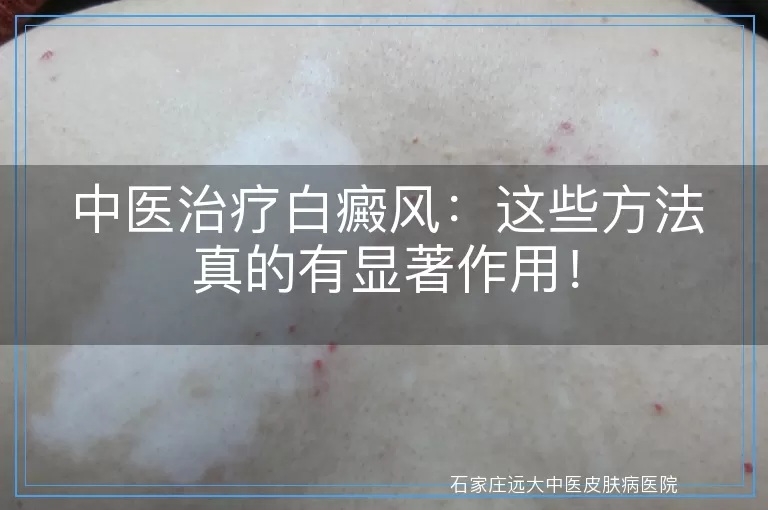 中医治疗白癜风：这些方法真的有显著作用！