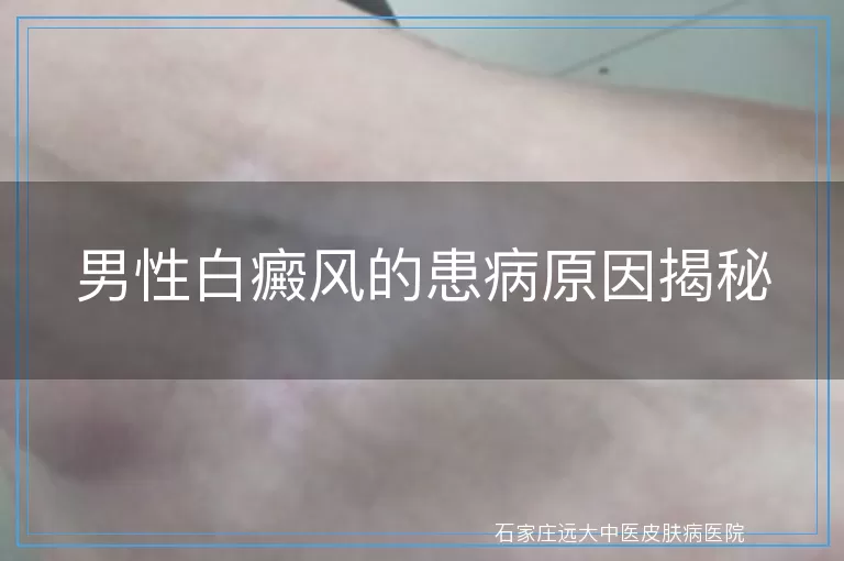 男性白癜风的患病原因揭秘