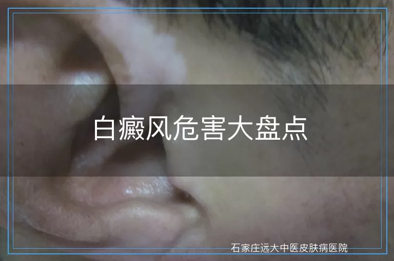 白癜风危害大盘点