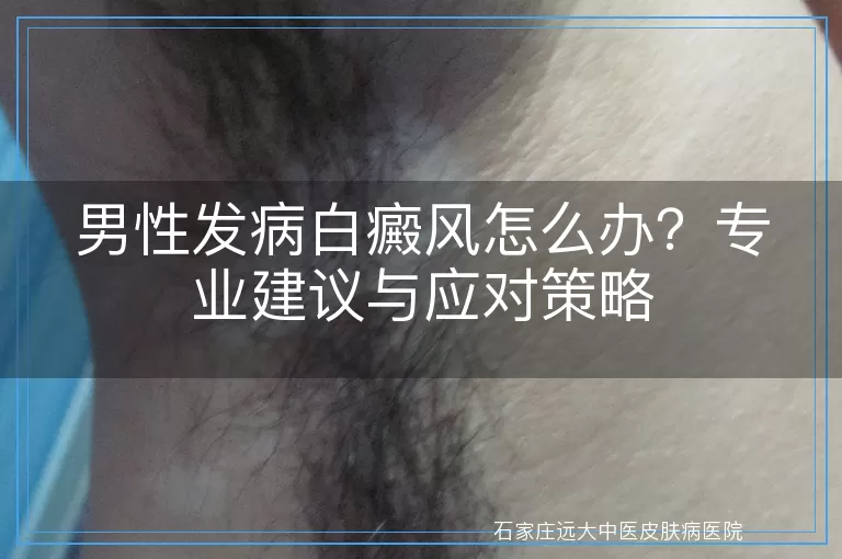 男性发病白癜风怎么办？专业建议与应对策略