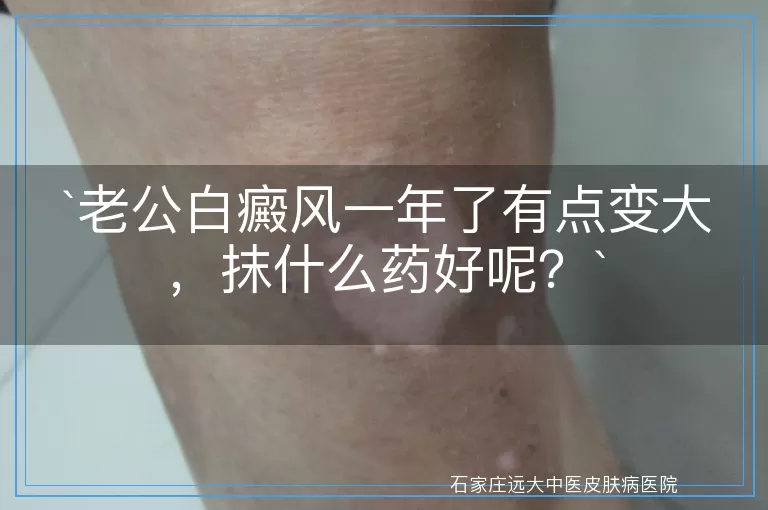 老公白癜风一年了有点变大，抹什么药好呢？