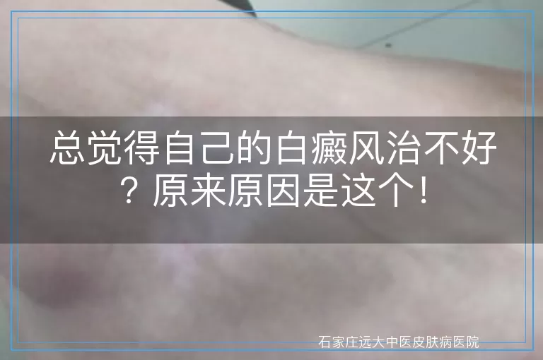 总觉得自己的白癜风治不好? 原来原因是这个！