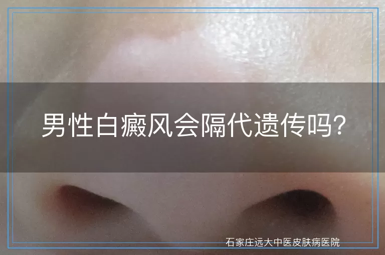 男性白癜风会隔代遗传吗？