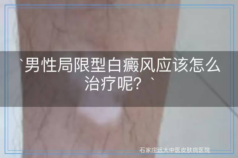 男性局限型白癜风应该怎么治疗呢？