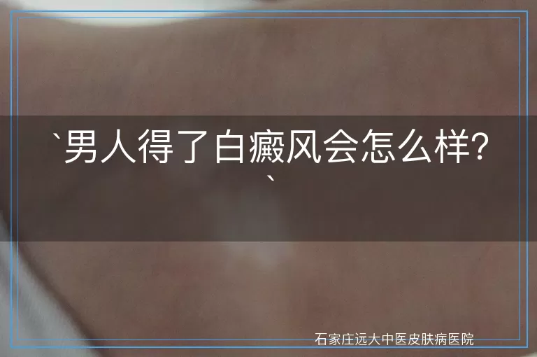 男人得了白癜风会怎么样？