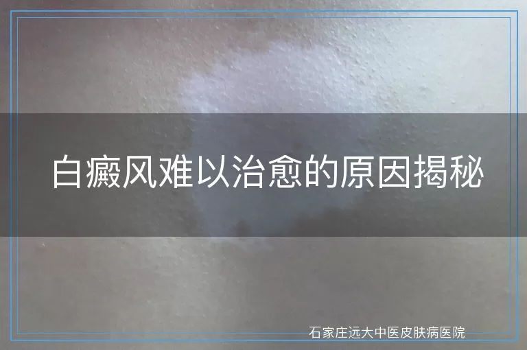 白癜风难以治愈的原因揭秘