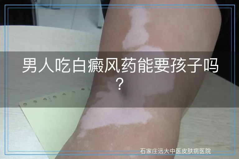男人吃白癜风药能要孩子吗？
