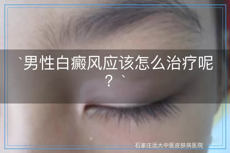 男性白癜风应该怎么治疗呢？