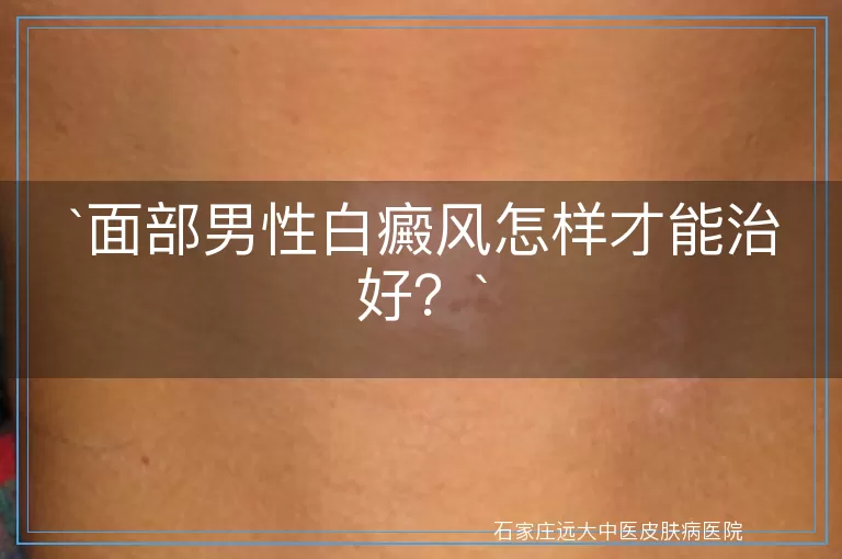 面部男性白癜风怎样才能治好？