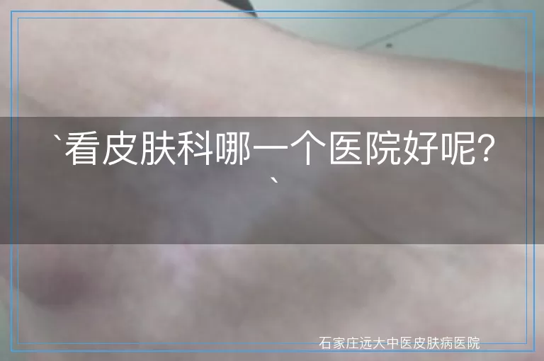 看皮肤科哪一个医院好呢？