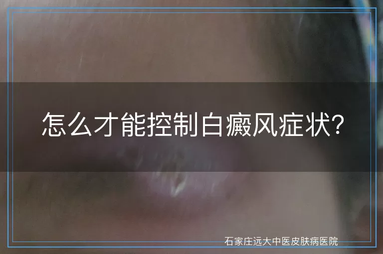 怎么才能控制白癜风症状？