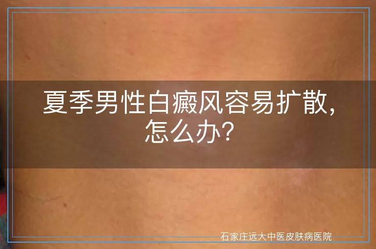 夏季男性白癜风容易扩散，怎么办？