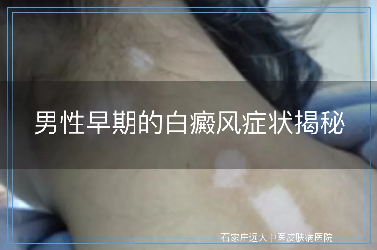 男性早期的白癜风症状揭秘