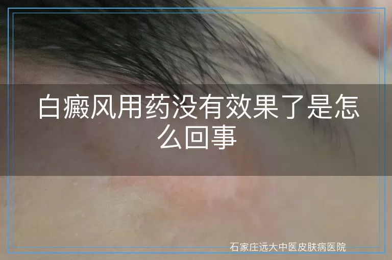 白癜风用药没有效果了是怎么回事