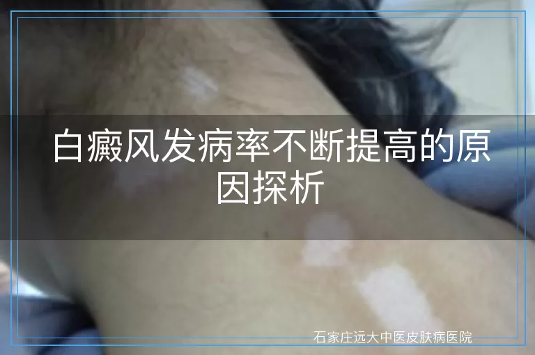 白癜风发病率不断提高的原因探析