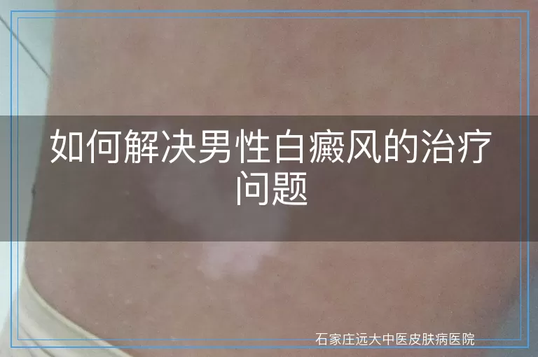 如何解决男性白癜风的治疗问题