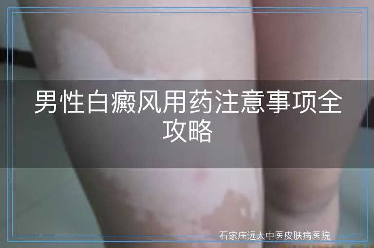 男性白癜风用药注意事项全攻略