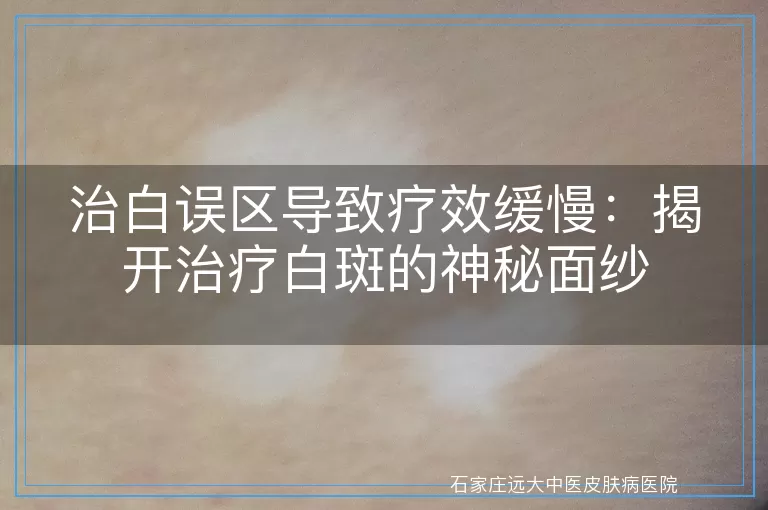 治白误区导致疗效缓慢：揭开治疗白斑的神秘面纱