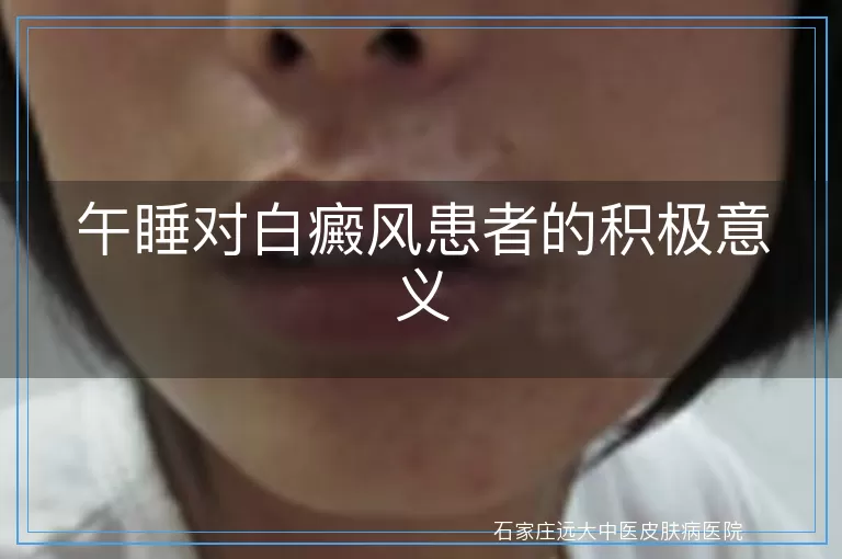午睡对白癜风患者的积极意义