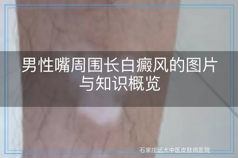 男性嘴周围长白癜风的图片与知识概览