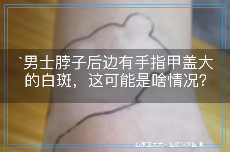 男士脖子后边有手指甲盖大的白斑，这可能是啥情况？