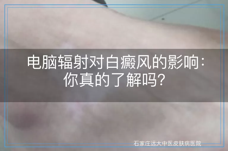 电脑辐射对白癜风的影响：你真的了解吗？