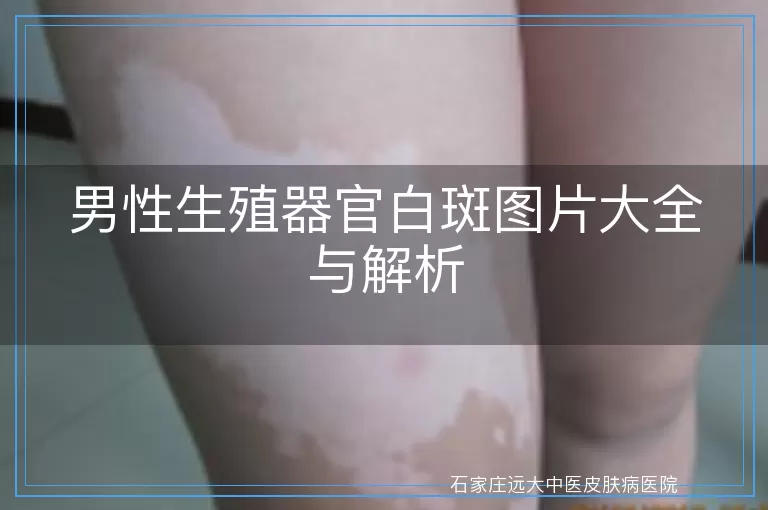 男性生殖器官白斑图片大全与解析