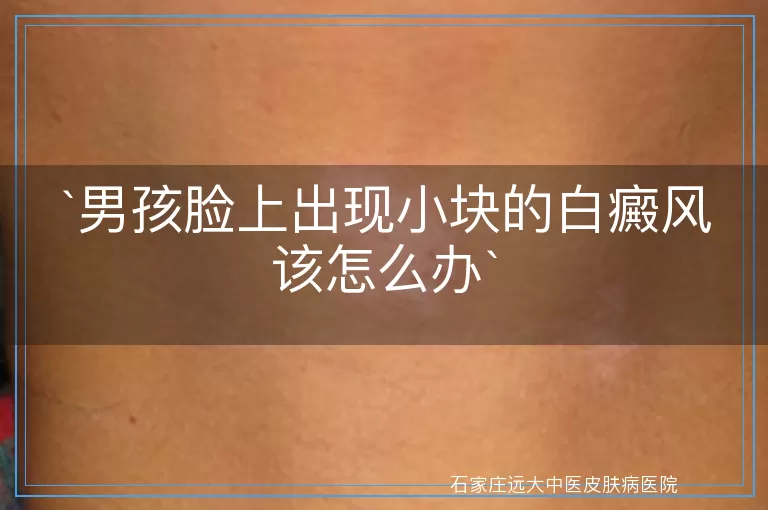 男孩脸上出现小块的白癜风该怎么办