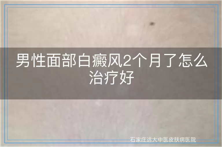 男性面部白癜风2个月了怎么治疗好