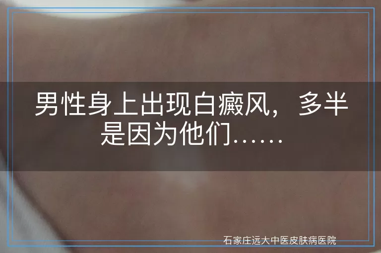 男性身上出现白癜风，多半是因为他们……