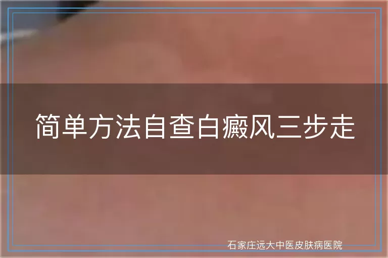 简单方法自查白癜风三步走