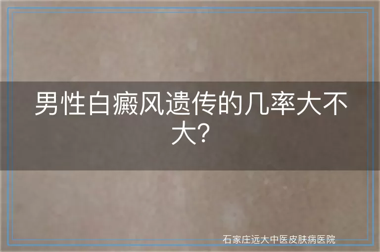 男性白癜风遗传的几率大不大？