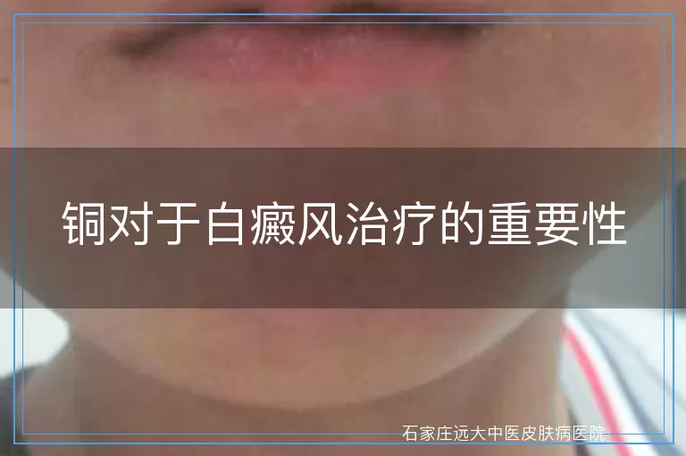 铜对于白癜风治疗的重要性