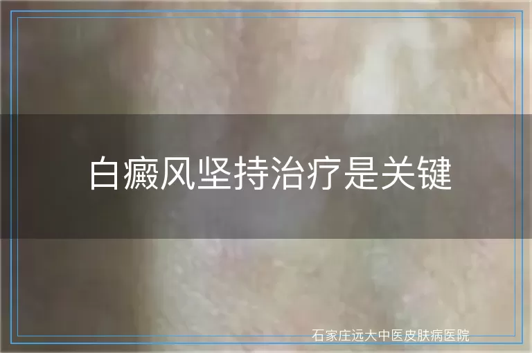 白癜风坚持治疗是关键