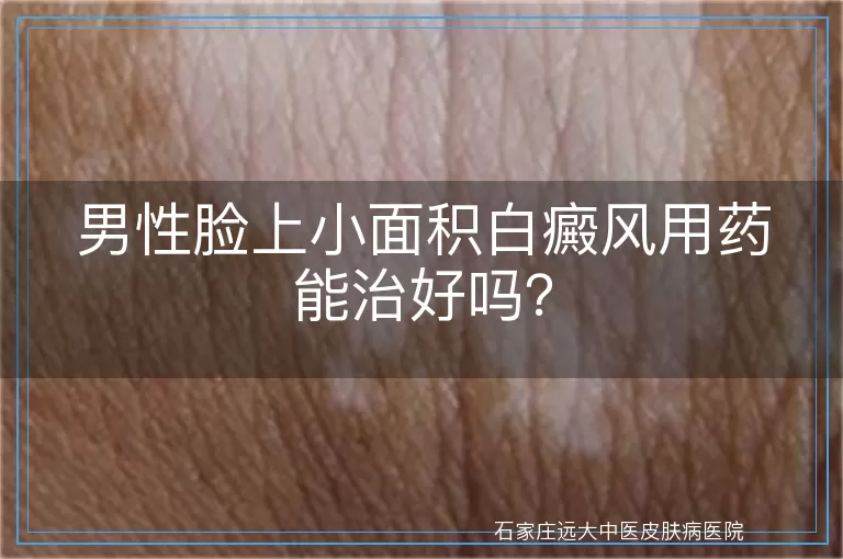 男性脸上小面积白癜风用药能治好吗？