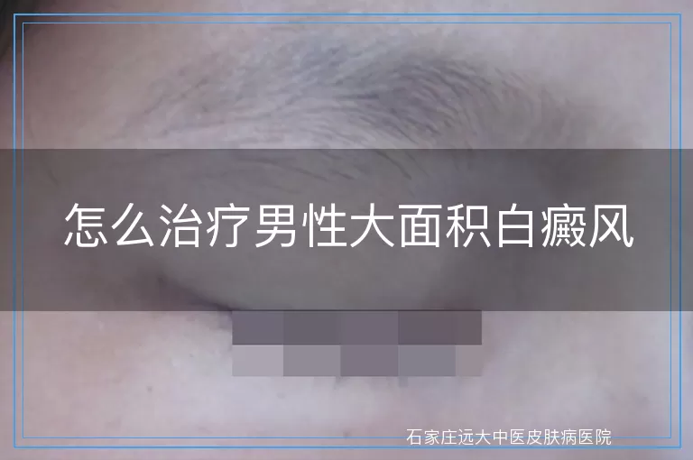 怎么治疗男性大面积白癜风
