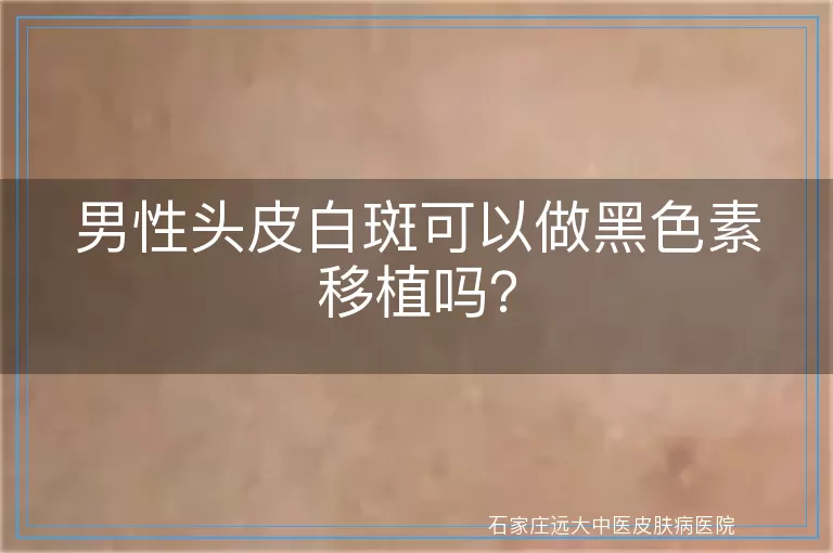 男性头皮白斑可以做黑色素移植吗？