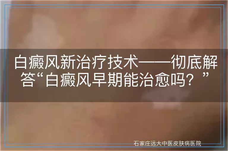 白癜风新治疗技术——彻底解答“白癜风早期能治愈吗？”