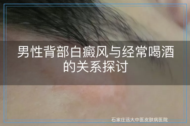 男性背部白癜风与经常喝酒的关系探讨