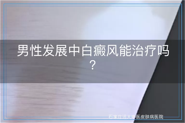 男性发展中白癜风能治疗吗？