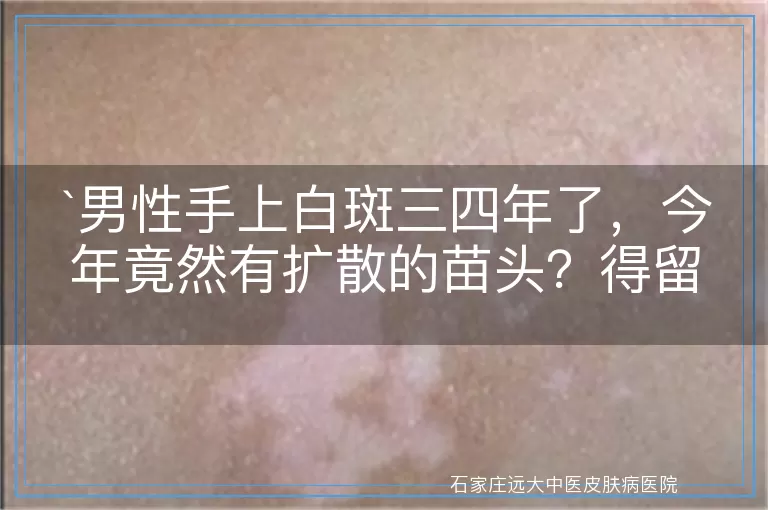 男性手上白斑三四年了，今年竟然有扩散的苗头？得留意了！