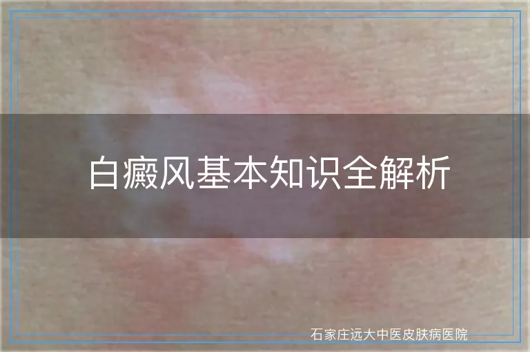 白癜风基本知识全解析
