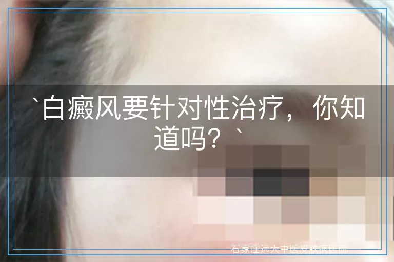 白癜风要针对性治疗，你知道吗？