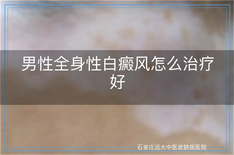男性全身性白癜风怎么治疗好