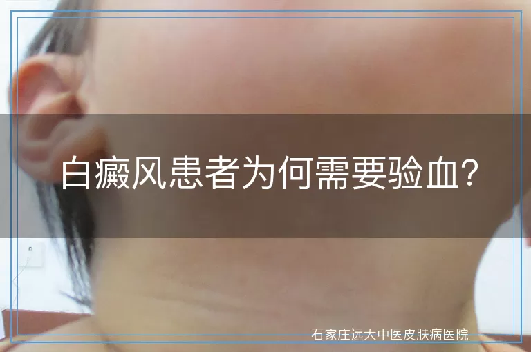 白癜风患者为何需要验血？