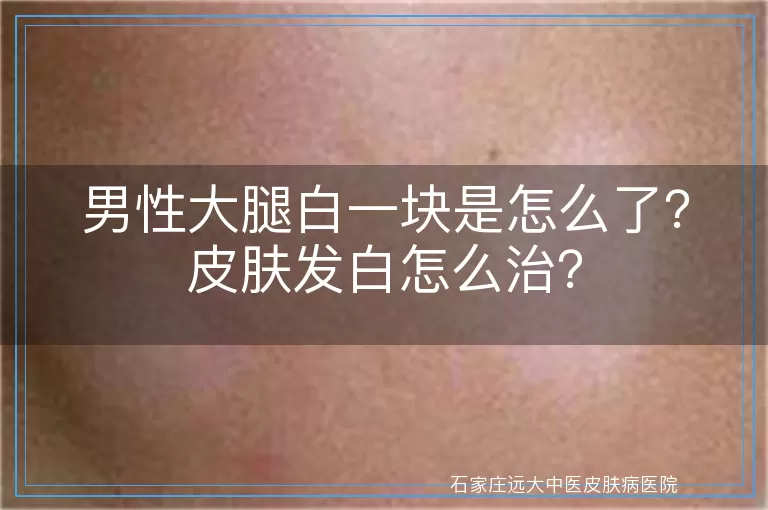 男性大腿白一块是怎么了？皮肤发白怎么治？