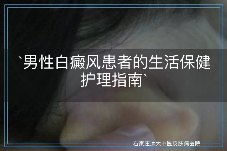 男性白癜风患者的生活保健护理指南