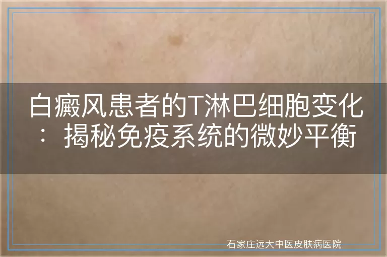白癜风患者的T淋巴细胞变化：揭秘免疫系统的微妙平衡