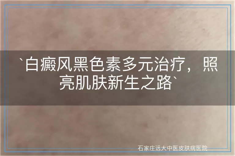 白癜风黑色素多元治疗，照亮肌肤新生之路