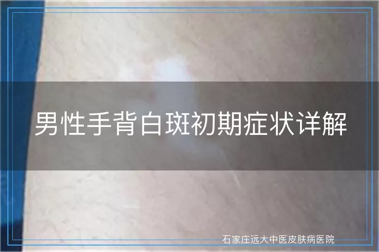 男性手背白斑初期症状详解